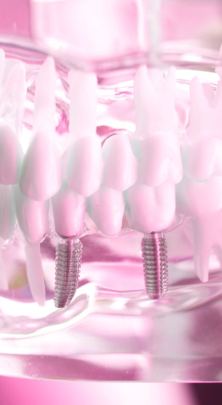Maqueta dental de un implante